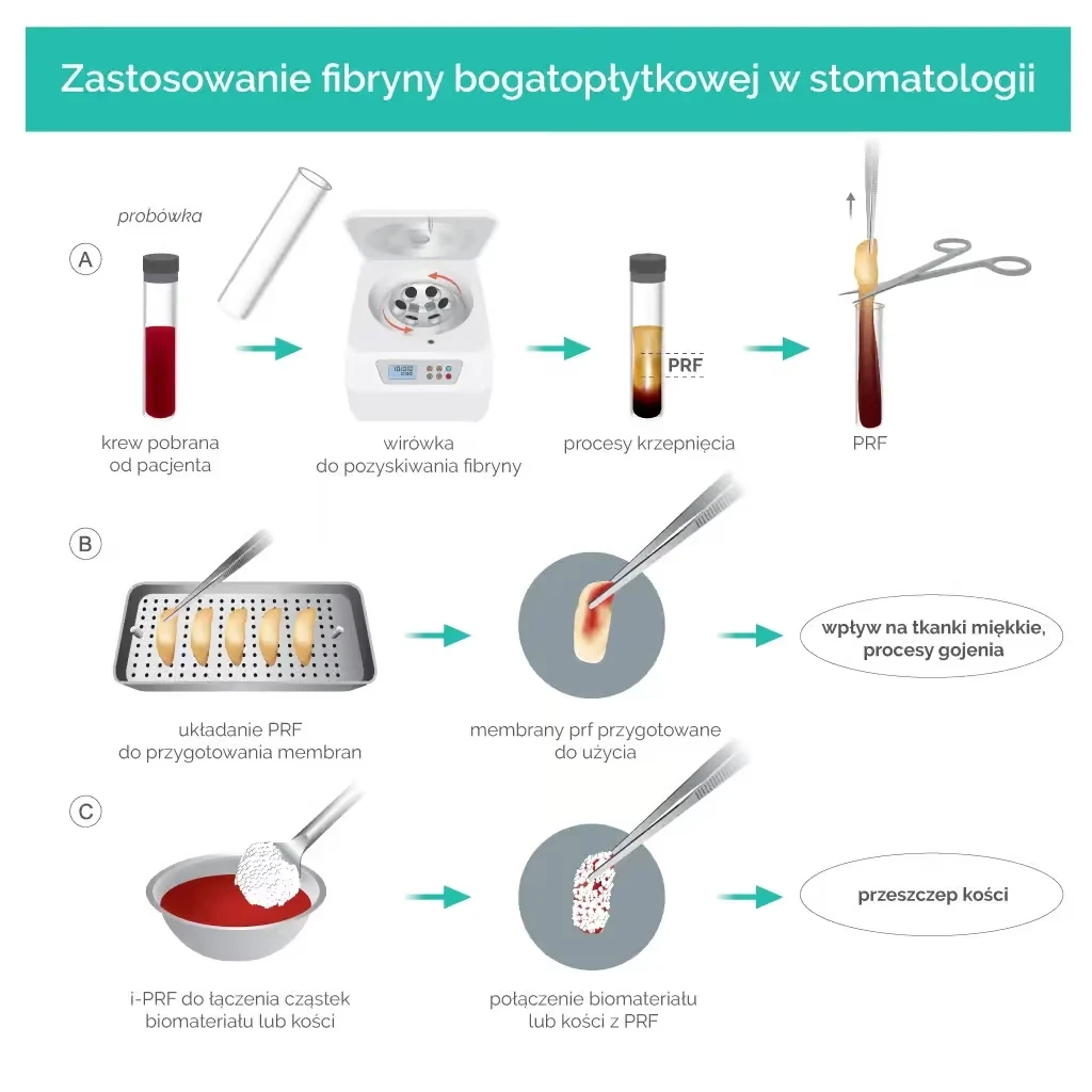 PRF i regeneracja kości