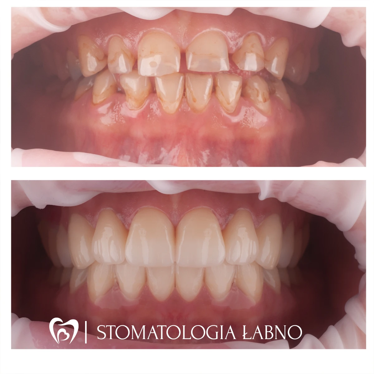 Przypadek leczenia w Stomatologii Łabno