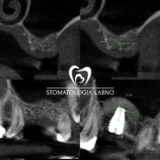 Przypadek leczenia w Stomatologii Łabno