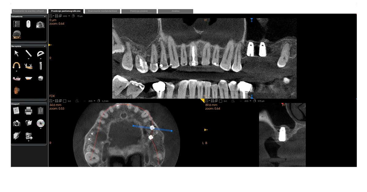 Przypadek implantacji - dokumentacja 7