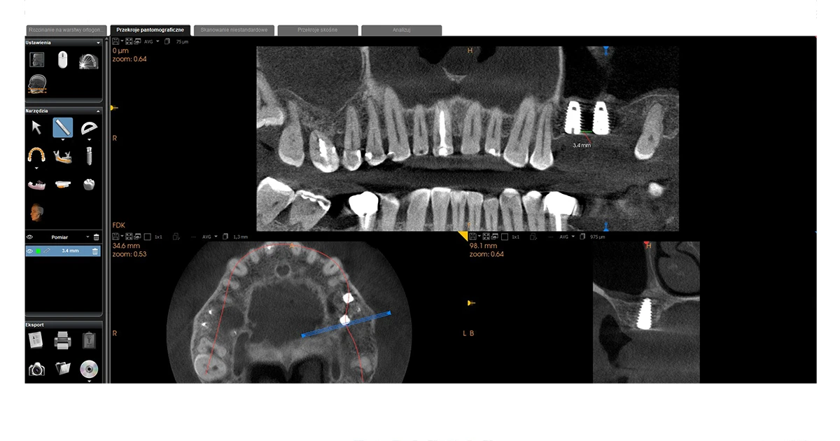 Przypadek implantacji - dokumentacja 8